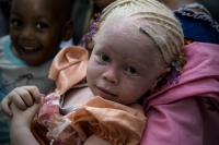 Dans certains cas, les yeux d’un albinos ne présentent pas le signe d’albinisme. 