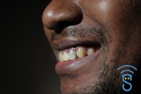 La solution pour les dents mortes est la recouverture avec une prothèse dentaire. 