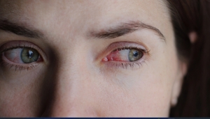 La conjonctivite infectieuse est la maladie infectieuse des yeux la plus fréquente
