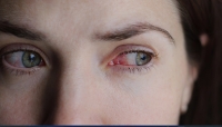 La conjonctivite infectieuse est la maladie infectieuse des yeux la plus fréquente