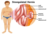 Diagramme d’une hernie étranglée homme 