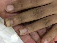 Certains médicaments sont à l’origine des ongles jaunes 