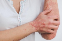 Les maladies de la peau peuvent se manifester par des démangeaisons, des vésicules ou par une peau sèche  etc. 
