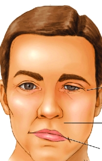 Le traitement de la paralysie faciale périphérique et centrale varie en fonction de la cause sous-jacente