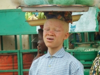 L’enlèvement des personnes atteintes d’albinisme persiste